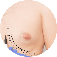 Symptoms Of Gynecomastia Increase In Areola Treatment In Trivandrum