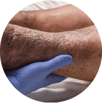 Symptoms of Diabetic Foot Ulcer - Thickening of Skin 