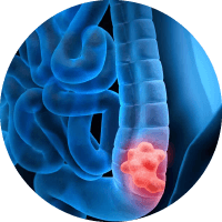 Causes Of Appendicitis Treatment Cancerous Parasite Or Tumor Treatment Mumbai 