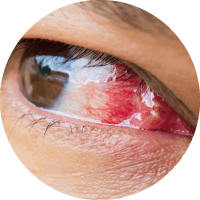 Causes of Lasik Cornea Inflammation due to Eye Diseases Treatment In Mumbai 