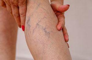 laser treatment for varicose veins  In Thrissur