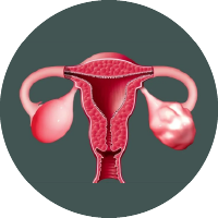 Irregular Periods Due To Uterine Fibroids Treatment In Palakkad