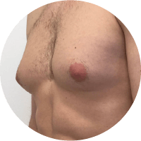 Symptoms Of Gynecomastia Discharge From Nipples In One Or Both Treatment In Thrissur 