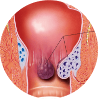 Symptoms Of Fistula Perianal Abscess Treatment Thrissur