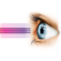 Causes Of Cataract Surgery UV Radiations Treatment In Thrissur  